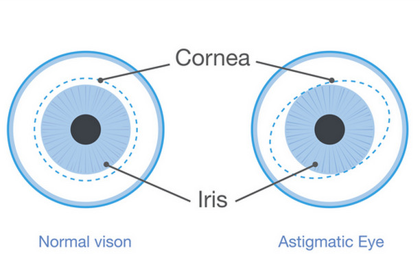 Astigmatism vs. Normal Vision