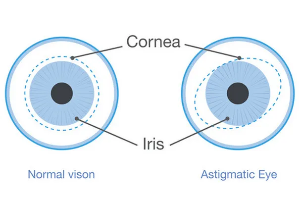 Astigmatism vs. Normal Vision: A Detailed Look at Key Differences